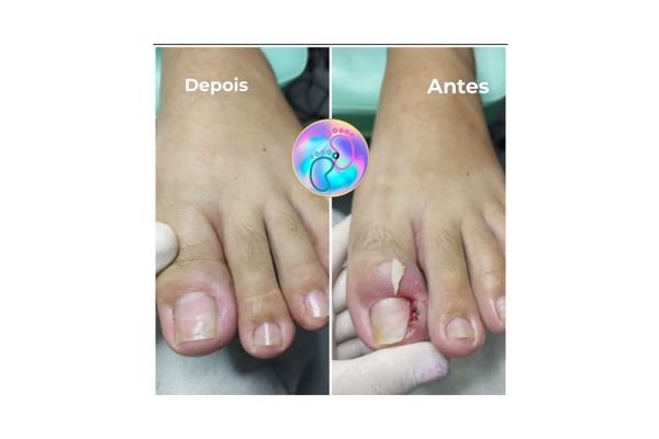 Foto de antes e depois do tratamento 16
